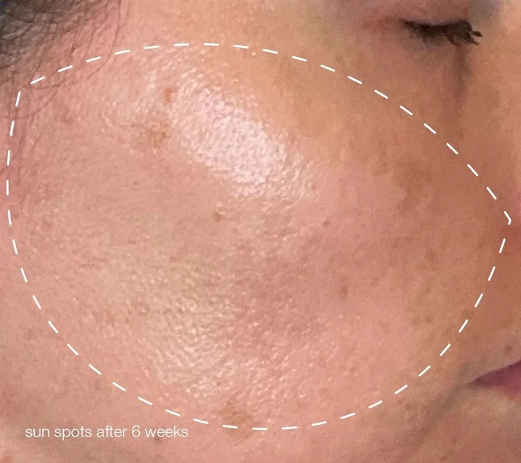 Same cheek with faded sun spots after 6 weeks of the Melanopro Peel program
