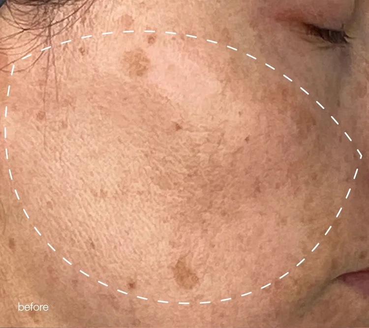 Cheek with visible sun spots before the Melanopro Peel program