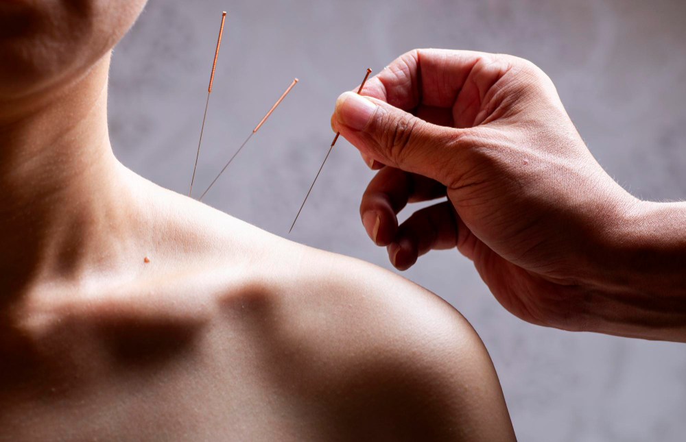 Why choose our naturopathic acupuncture care