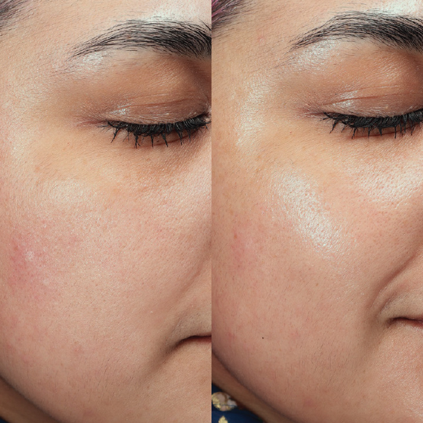 Plump Peel facial before and after results showing smoother, more hydrated skin