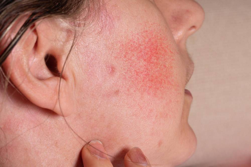 Rosacea, Sensitive Skin, and Why Gentle Treatments Matter More Than You Think
